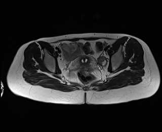 File:Bicornuate bicollis uterus (Radiopaedia 61626-69616 Axial T2 23).jpg