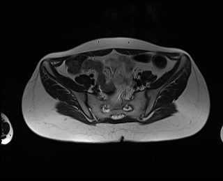 File:Bicornuate bicollis uterus (Radiopaedia 61626-69616 Axial T2 7).jpg