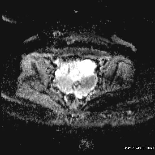 File:Bicornuate uterus- on MRI (Radiopaedia 49206-54297 Axial ADC 14).jpg