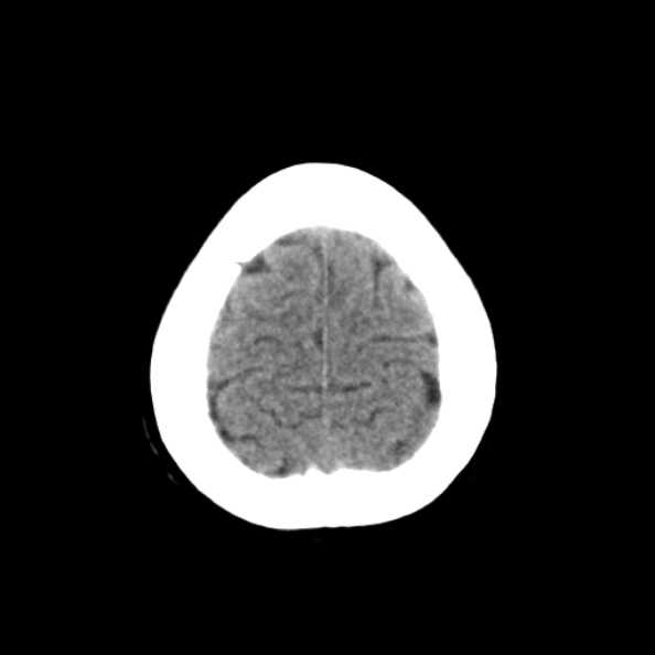 File:Bilateral PCA territory infarction - different ages (Radiopaedia 46200-50591 Axial non-contrast 21).jpg