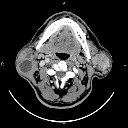 File:Bilateral Warthin tumors (Radiopaedia 84034-99263 Axial With contrast 30).jpg