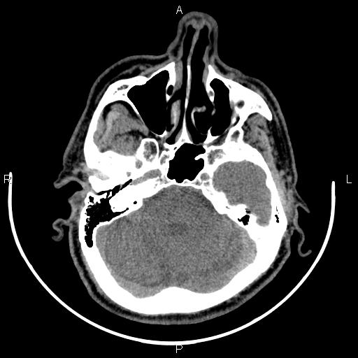 Bilateral Warthin tumors (Radiopaedia 84034-99263 Axial non-contrast 3).jpg