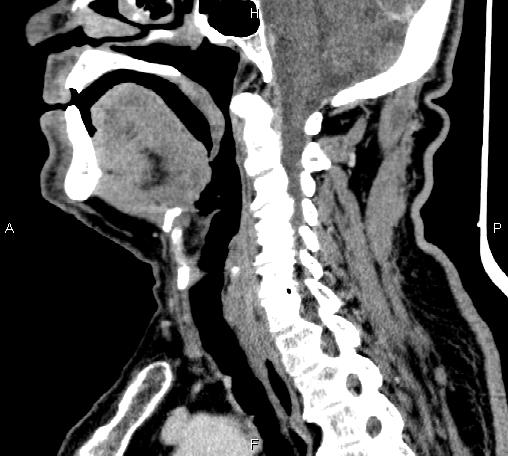 Bilateral Warthin tumors (Radiopaedia 84034-99263 D 43).jpg