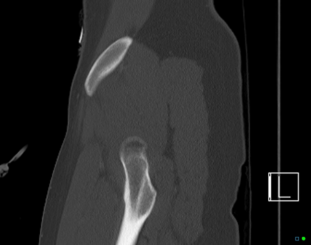 Bilateral acetabular fractures (Radiopaedia 79272-92308 Sagittal bone window 11).jpg