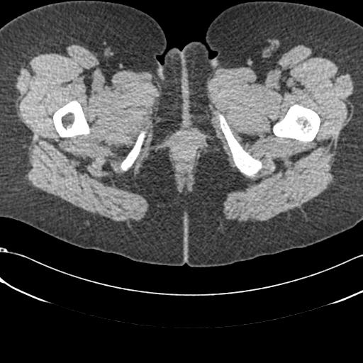 File:Bilateral acetabular protrusion with pincer type femoro-acetabular impingement (Radiopaedia 30134-30733 AXIAL SOFT THIN 111).jpg