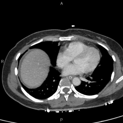 File:Bilateral adrenal gland hyperenhancement in pancreatitis (Radiopaedia 86642-102753 E 1).jpg