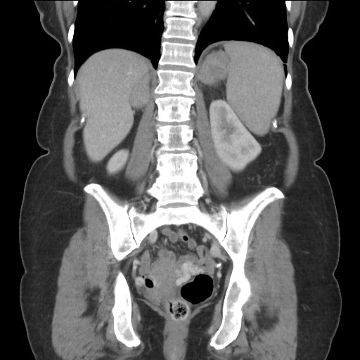 Bilateral adrenal granulocytic sarcomas (chloromas) (Radiopaedia 78375-91007 B 64).jpg