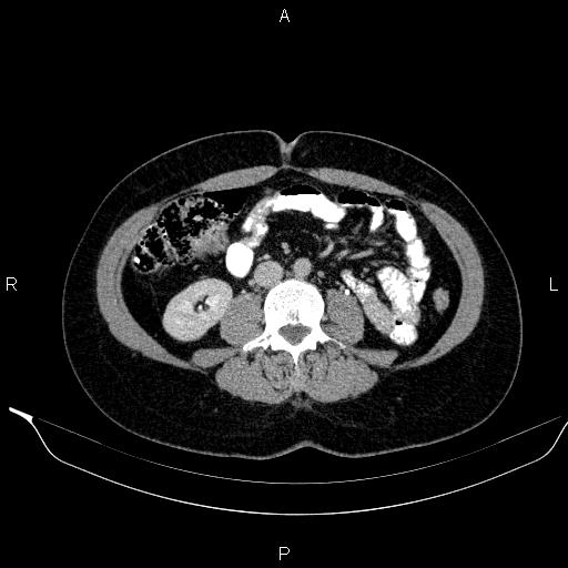 File:Bilateral adrenal myelolipoma (Radiopaedia 63058-71535 Axial C+ delayed 77).jpg