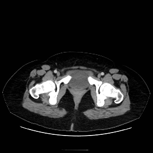Bilateral adrenal thrombosis (Radiopaedia 58182-65256 A 78).jpg