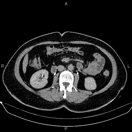 File:Bilateral benign adrenal adenomas (Radiopaedia 86912-103124 Axial C+ delayed 73).jpg