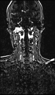 Bilateral carotid body tumors and right glomus jugulare tumor (Radiopaedia 20024-20060 MRA 120).jpg