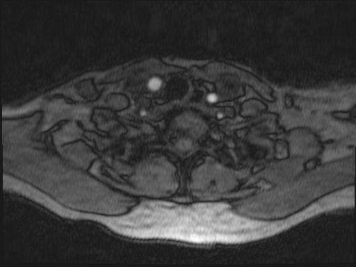 File:Bilateral carotid body tumors and right jugular paraganglioma (Radiopaedia 20024-20060 Axial 307).jpg