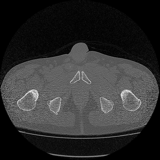 Bilateral femoral neck stress fractures (Radiopaedia 28666-28954 Axial bone window 69).png