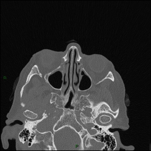 Bilateral frontal mucoceles (Radiopaedia 82352-96454 Axial bone window 170).jpg