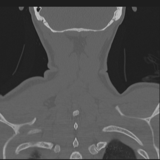 File:Bilateral locked facets (Radiopaedia 33850-35016 Coronal bone window 79).png