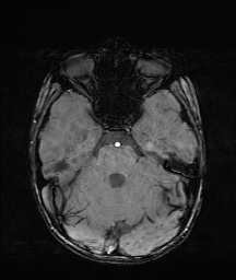 File:Bilateral mesial temporal polymicrogyria (Radiopaedia 76456-88181 Axial SWI 18).jpg
