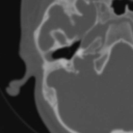 Bilateral otosclerosis (Radiopaedia 57237-64157 B 45).jpg