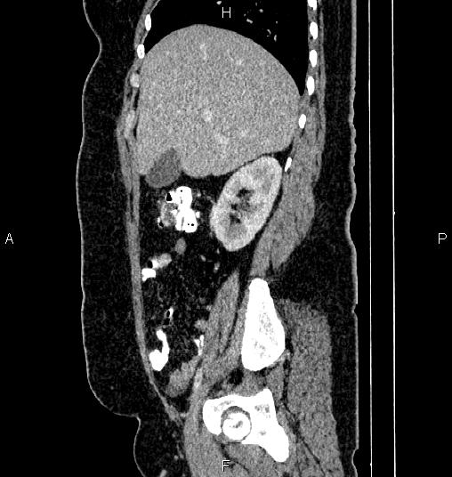 Bilateral ovarian dermoid cysts (Radiopaedia 85785-101603 D 23).jpg
