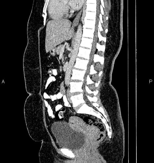 File:Bilateral ovarian dermoid cysts (Radiopaedia 85785-101603 D 47).jpg