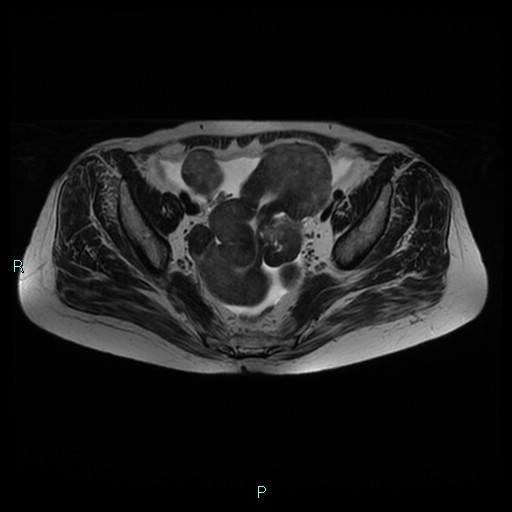 File:Bilateral ovarian fibroma (Radiopaedia 44568-48293 Axial T2 13).jpg