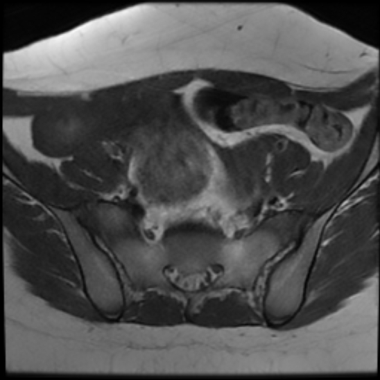 File:Bilateral ovarian fibrothecomas - adolescent (Radiopaedia 86604-102707 Axial T1 9).jpg