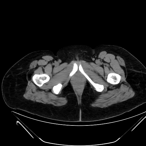 File:Bilateral ovarian mature cystic teratomas (Radiopaedia 79373-92457 Axial non-contrast 100).jpg