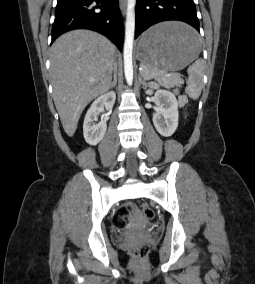 File:Bilateral ovarian mature cystic teratomas (Radiopaedia 79373-92457 B 55).jpg