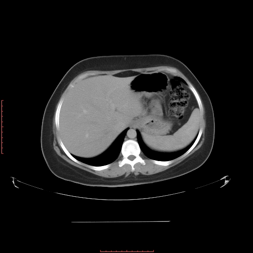 File:Bilateral ovarian serous cystadenocarcinoma with right ovarian torsion (Radiopaedia 32640-33611 A 8).jpg