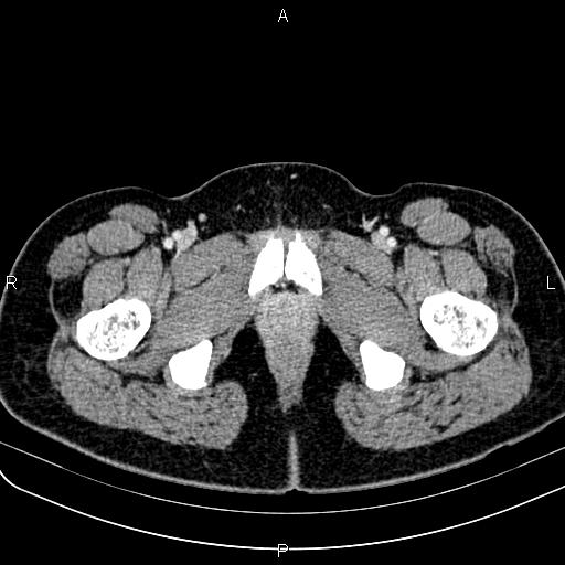 Bilateral ovarian teratoma (Radiopaedia 83131-97503 Axial With contrast 84).jpg