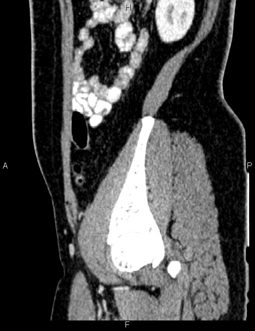 Bilateral ovarian teratoma (Radiopaedia 83131-97503 D 88).jpg