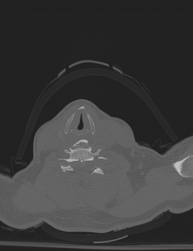 File:Bilateral perched facet joint (Radiopaedia 63149-71669 Axial bone window 44).jpg