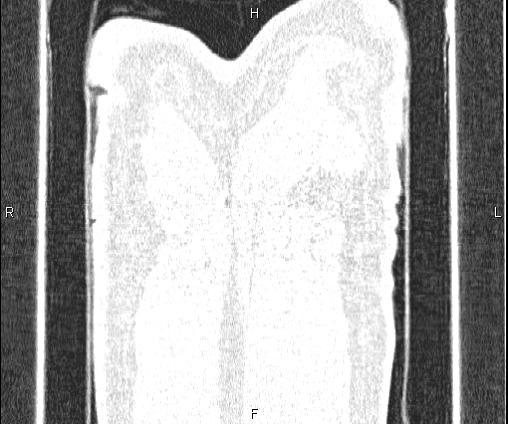 Bilateral pulmonary AVM (Radiopaedia 83134-97505 Coronal lung window 81).jpg