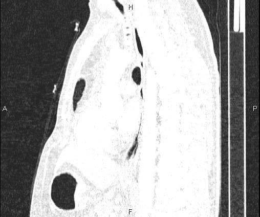 File:Bilateral pulmonary AVM (Radiopaedia 83134-97505 Sagittal lung window 63).jpg