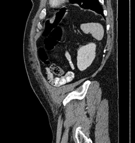 Bilateral rectus sheath hematomas (Radiopaedia 50778-56252 B 66).jpg