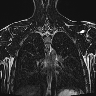 Bilateral spinoglenoid notch ganglion cysts (Radiopaedia 29577-30082 Coronal T2 87).jpg