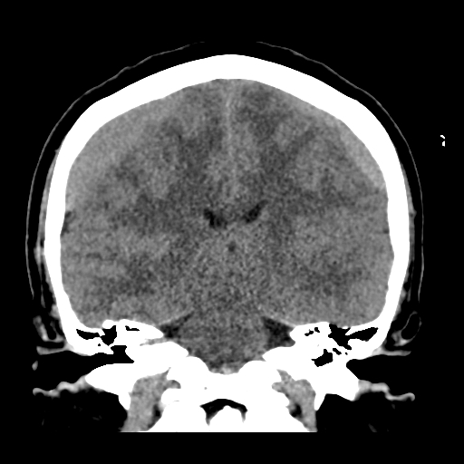 Bilateral subacute subdural hematoma (Radiopaedia 69240-79018 Coronal non-contrast 33).jpg