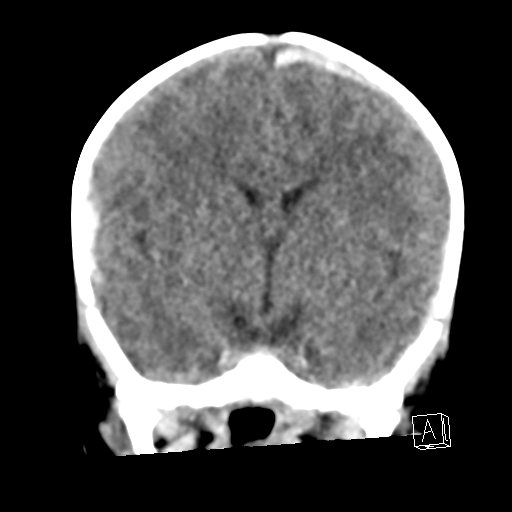 File:Bilateral subdural hemorrhage and parietal skull fracture (Radiopaedia 26058-26192 Coronal non-contrast 12).png