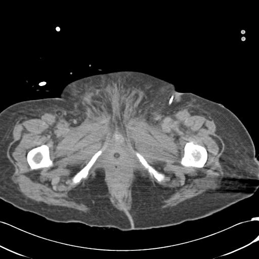 File:Bladder rupture post renal biopsy (Radiopaedia 30863-31572 Axial non-contrast 93).jpg