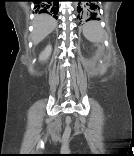 Bladder rupture post renal biopsy (Radiopaedia 30863-31572 Coronal non-contrast 47).jpg