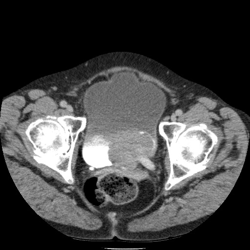 Bladder tumor detected on trauma CT (Radiopaedia 51809-57609 C 131).jpg