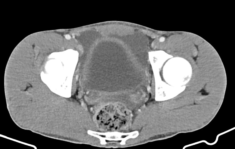 Blunt injury to the small bowel (Radiopaedia 74953-85987 A 176).jpg