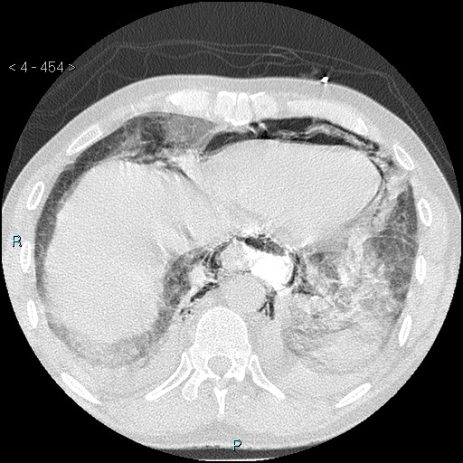 File:Boerhaave syndrome (Radiopaedia 27683-27897 lung window 86).jpg