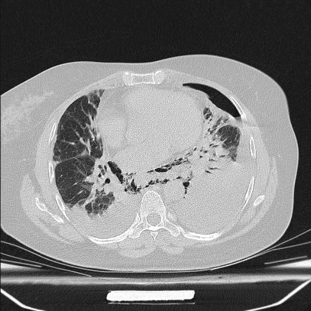 Boerhaave syndrome (Radiopaedia 45644-49799 Axial lung window 73).jpg