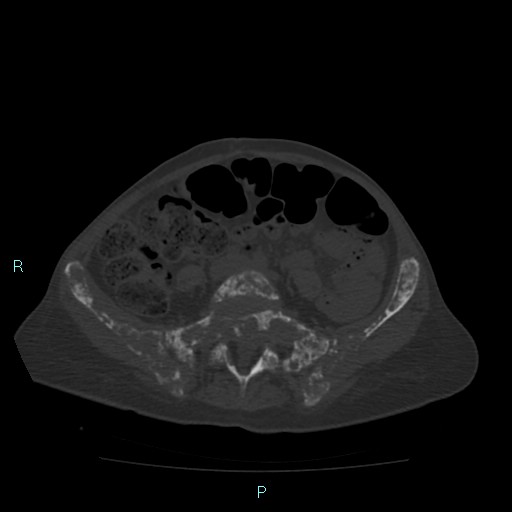 Bone metastases from untreated breast cancer (Radiopaedia 42973-46219 Axial bone window 143).jpg