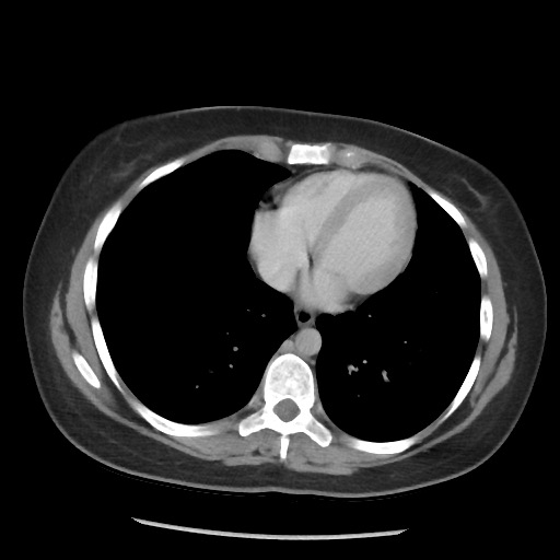 File:Borderline mucinous tumor (ovary) (Radiopaedia 78228-90808 A 60).jpg