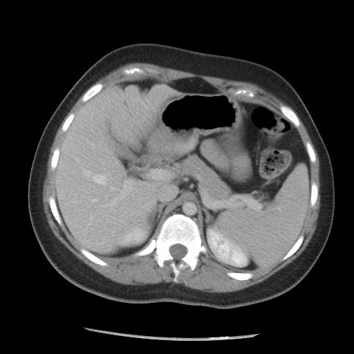 File:Borderline mucinous tumor (ovary) (Radiopaedia 78228-90808 A 74).jpg