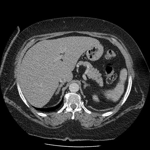 Bovine aortic arch - right internal mammary vein drains into the superior vena cava (Radiopaedia 63296-71875 A 172).jpg