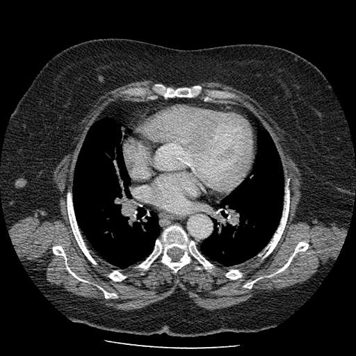 Bovine aortic arch - right internal mammary vein drains into the superior vena cava (Radiopaedia 63296-71875 A 81).jpg