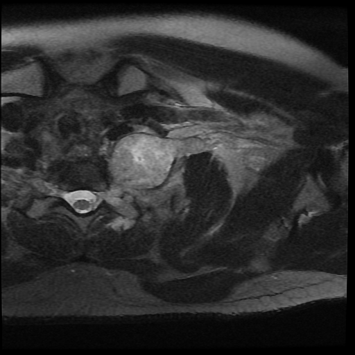 File:Brachial plexus neurofibroma (Radiopaedia 28030-28291 Axial T2 fat sat 8).png
