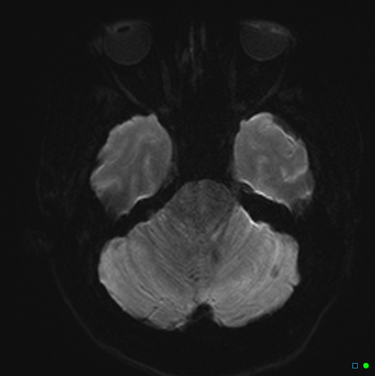 File:Brain death on MRI and CT angiography (Radiopaedia 42560-45689 Axial DWI 7).jpg